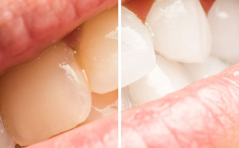 Bild Bleaching - Durch schonendes, fachgerechtes zahnärztliches Bleaching wirken die Zähne heller und weißer als zuvor, ohne bei der Behandlung beschädigt zu werden.