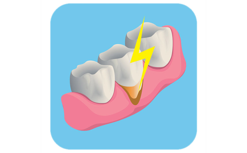 Bild Empfindliche Zahnhälse - Empfindliche Zahnhälse sind heute gut durch Beschichtung der Zahnhälse mit Fluoridlack, Kunststoff- oder Keramik zu behandeln.