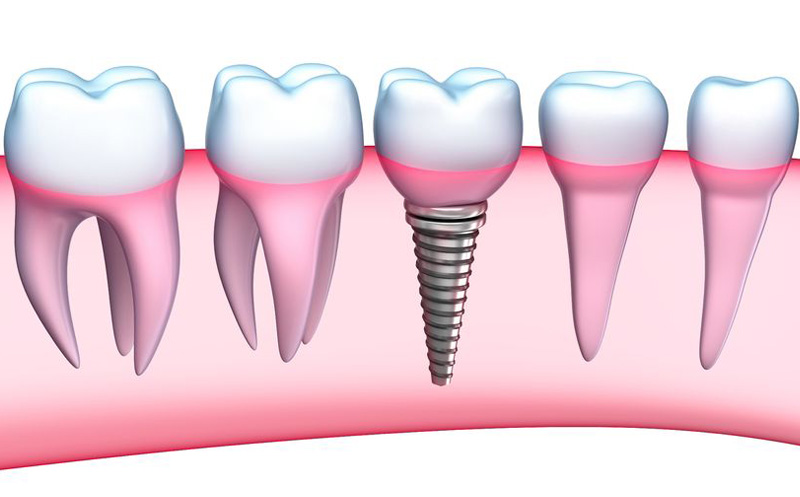 Bild Implantate - Die Zahnarztpraxis Dr. Heinemann-Fremerey in Hannover hat bereits über 7.000 Implantate gesetzt und findet auch in komplizierten Fällen die optimale Lösung für ihre Patienten.