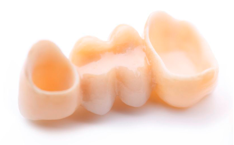 Bild Vollkeramikbrücken - Vollkeramikbrücken sind eine hochästhetische Alternative, Einen oder mehrere fehlende Zähne zu ersetzen, wenn Implantate nicht möglich sind.