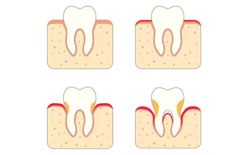 Bild Parodontites - Parodontites verläuft schleichend und oft unbemerkt. Folgen sind Zahnfleischrückgang bis zum Zahnausfall.  Eine Übertragung von Parodontitisbakterien in den Blutkreislauf kann auch verheerende Auswirkungen auf die Gesamtgesundheit haben.