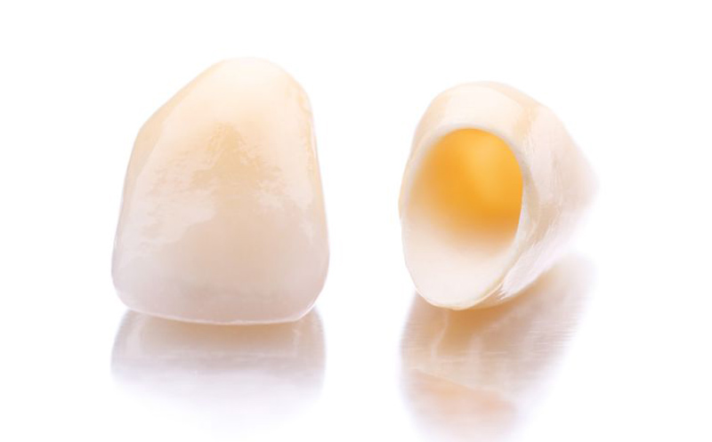 Bild Vollkermische Kronen- Vollkeramikkronen vereinen die Langlebigkeit und Belastbarkeit von Goldkronen und die Ästhetik der normalen Zähne.